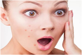 acne treatment in Noida