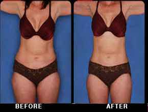 Weight loss treatment in Noida