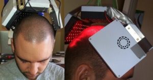 low level laser hair therapy clinic in Noida