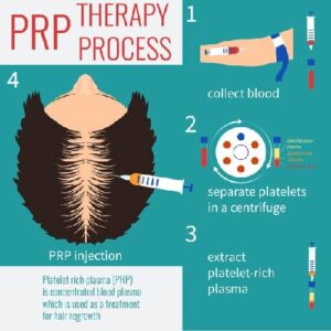 PRP hair treatment process