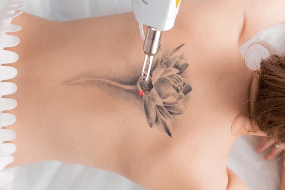 tattoo removal in Noida