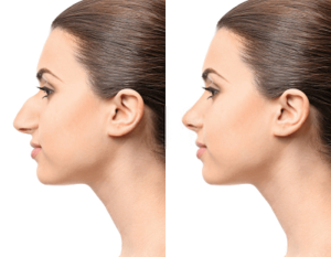 rhinoplastic surgery before after