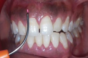 dental OPERATIVE ( LASER)