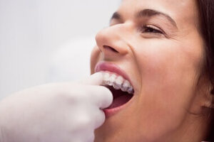 braces-in-noida-dental-clinic